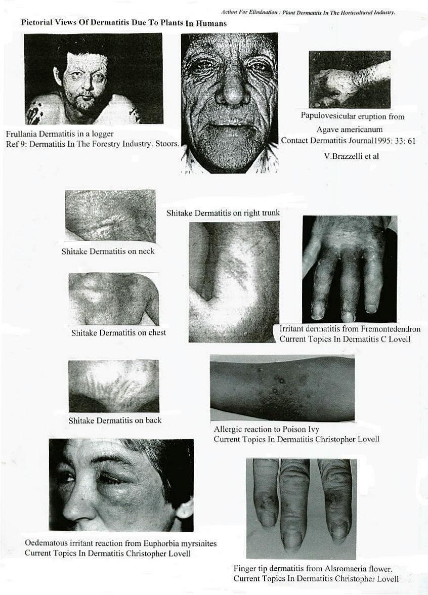 Plant Dermatitis